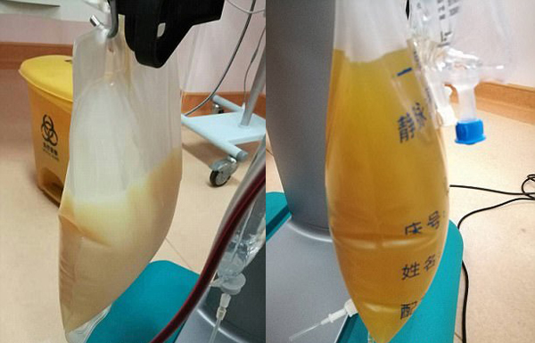 中山男子腹痛緊急送醫(yī)搶救，檢出“牛奶血”！