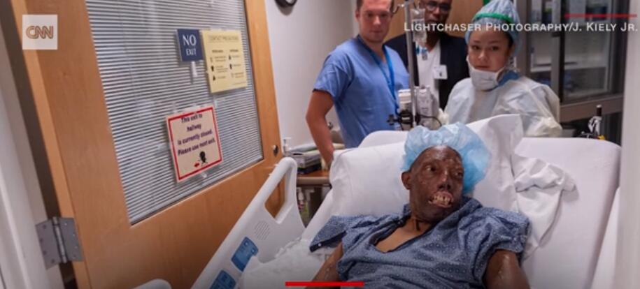 這名男子是第一個接受面部移植手術(shù)的非洲裔美國人